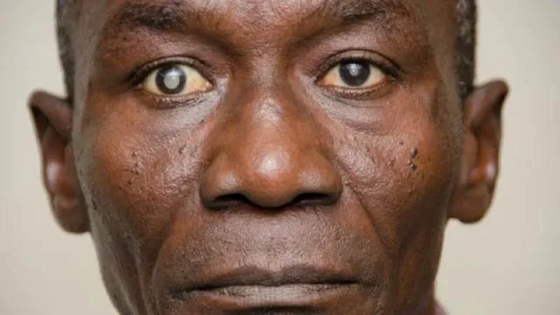 A close-up of an older man's eye with a visible cloudy, hazy lens, clearly showing the signs of a cataract.
