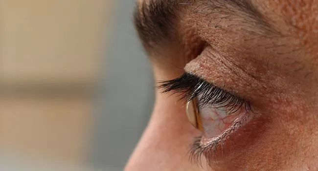 A side profile of a person's eye, illustrating the cone-like shape of the cornea associated with keratoconus and distorted vision.